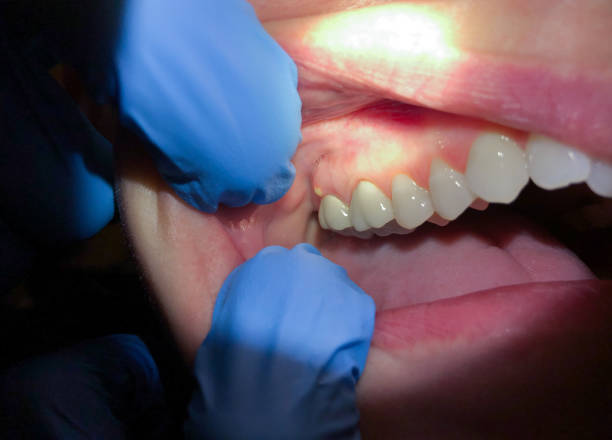 Best Emergency Broken Tooth Repair in West Fargo, ND